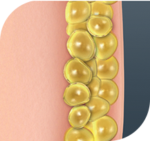 Coolsculpting Procedure - 8