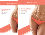 Coolsculpting Procedure - 12