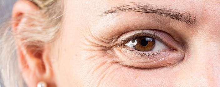 Blepharoplasty (Eyelid Surgery) Adelaide - 3